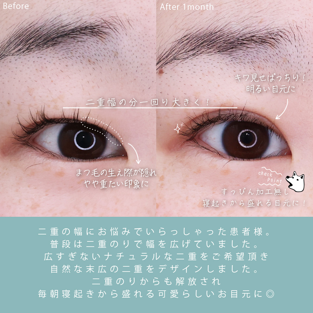 二重埋没法の症例写真 施術前後