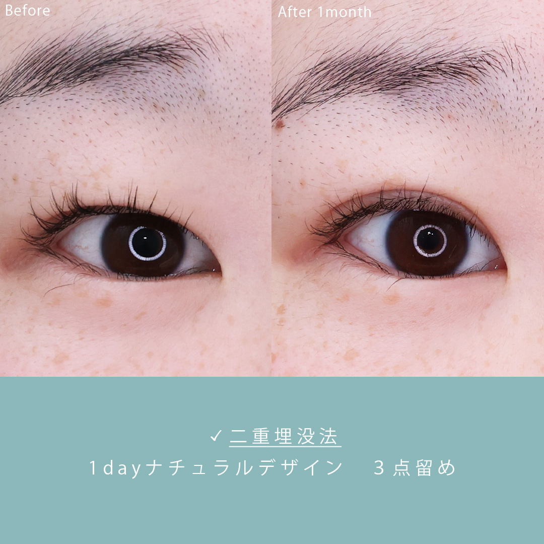 二重埋没法の症例写真 施術前後