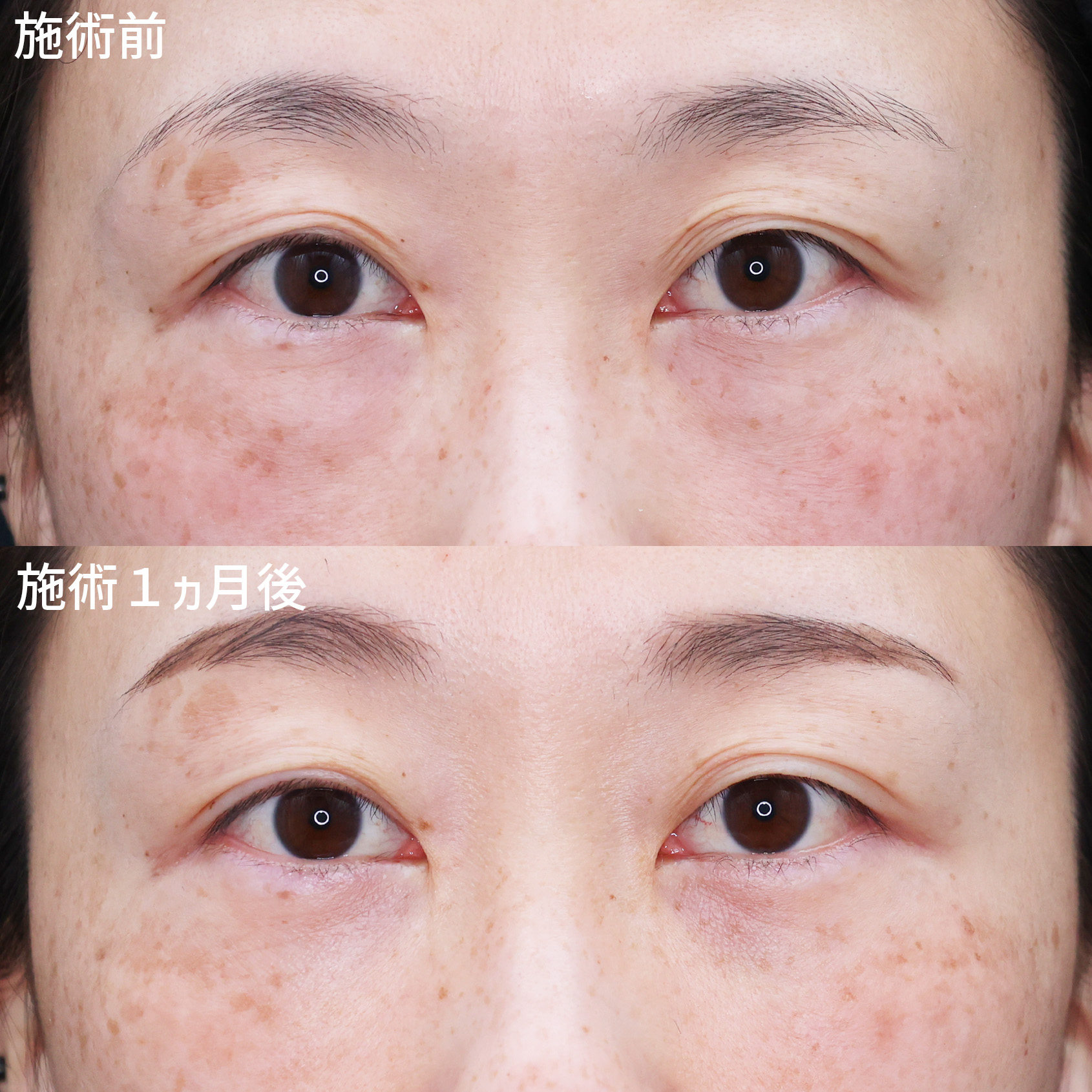 下眼瞼脱脂術(目の下のたるみ取り・目の下の脂肪ふくらみ取り)の症例写真 施術前後
