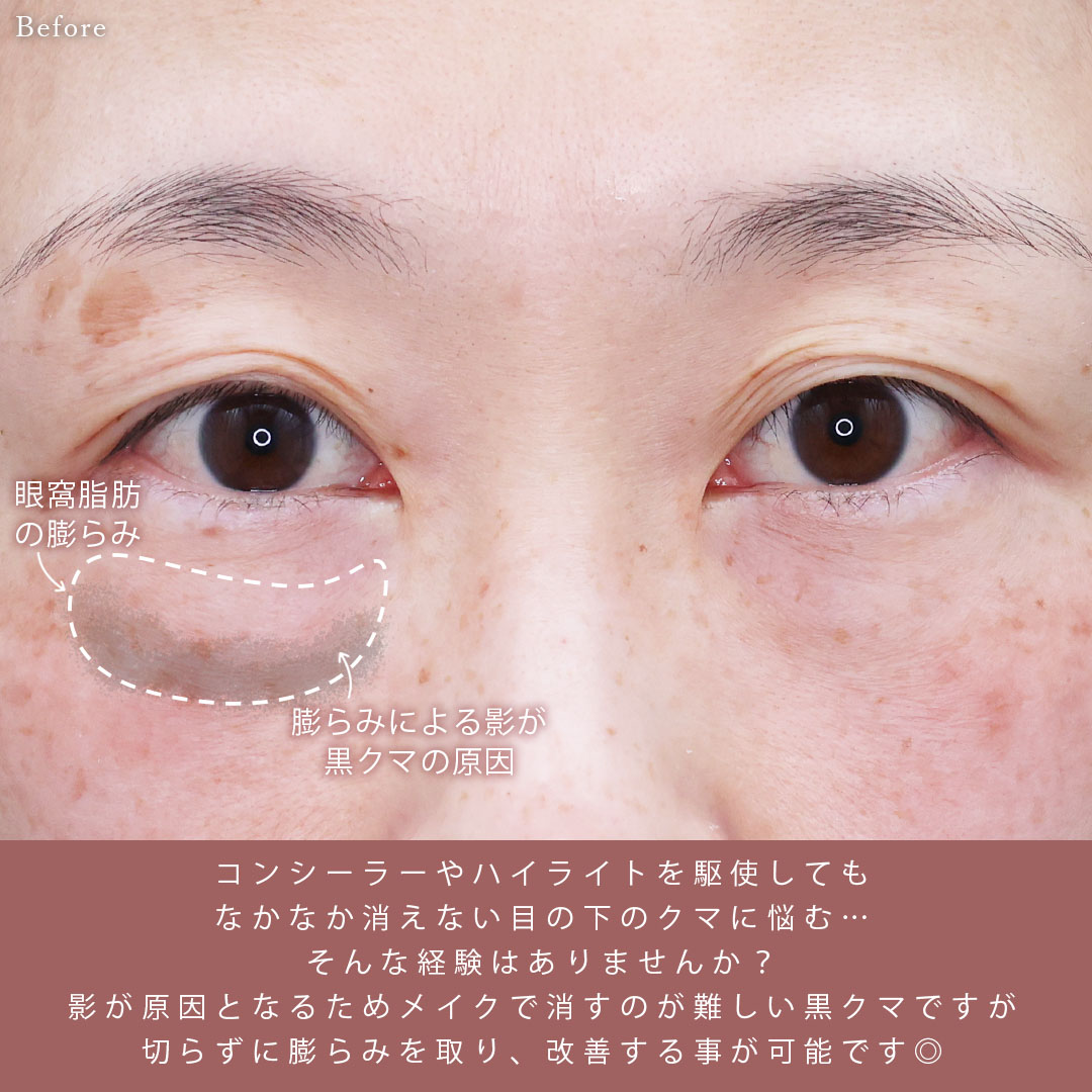 下眼瞼脱脂術(目の下のたるみ取り・目の下の脂肪ふくらみ取り)の症例写真 施術前後