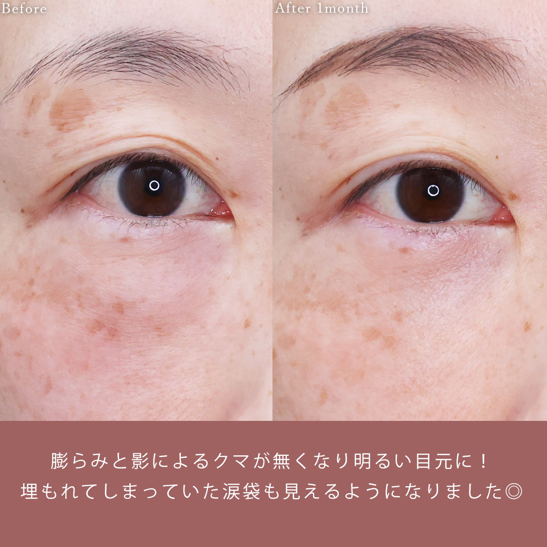 下眼瞼脱脂術(目の下のたるみ取り・目の下の脂肪ふくらみ取り)の症例写真 施術前後