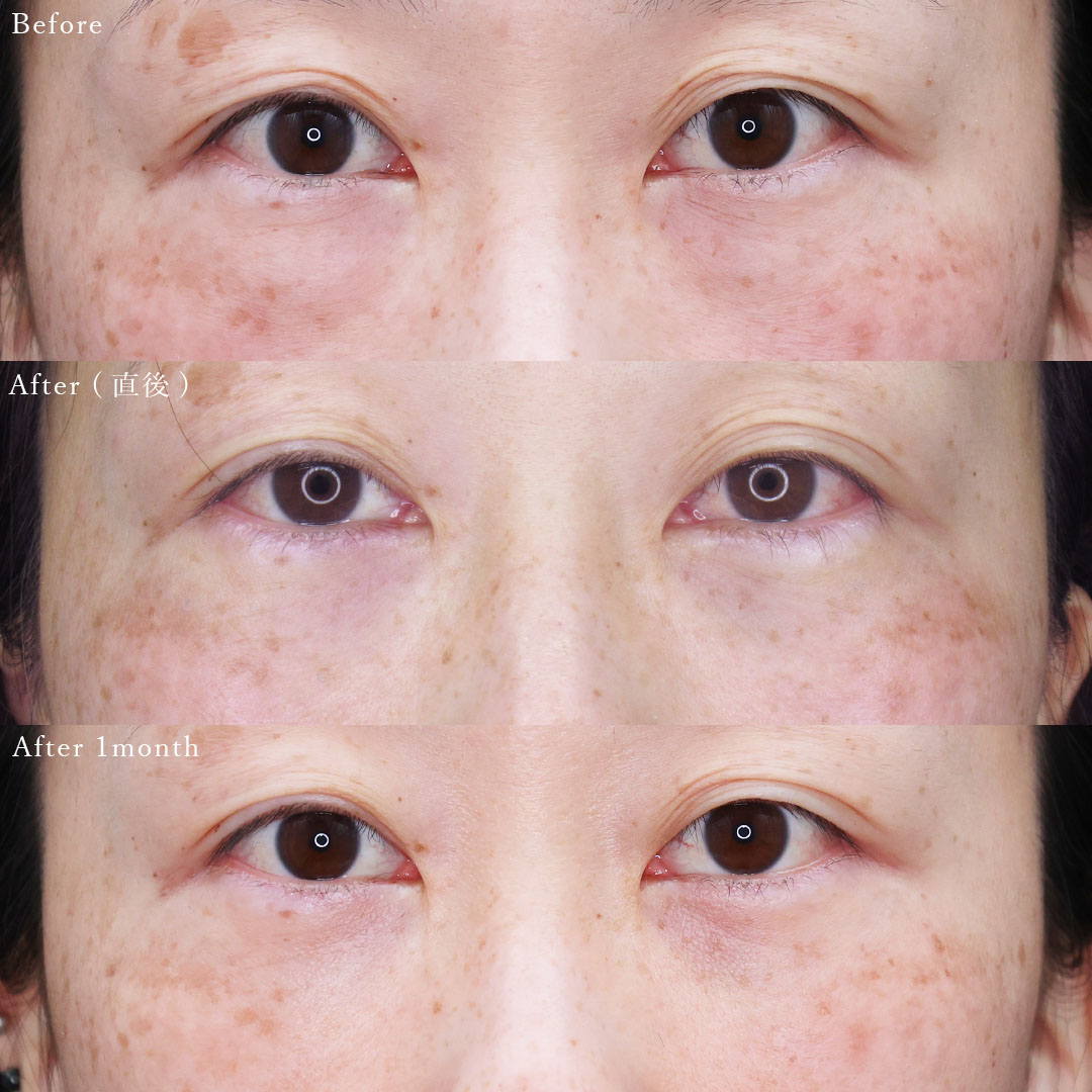 下眼瞼脱脂術(目の下のたるみ取り・目の下の脂肪ふくらみ取り)の症例写真 施術前後