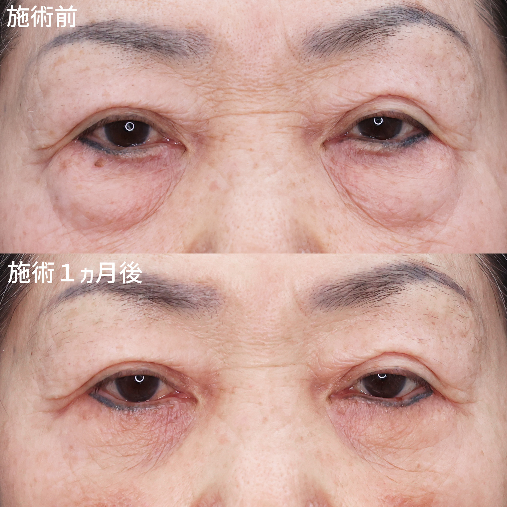 【クマ、たるみ取り】80代若返り美容