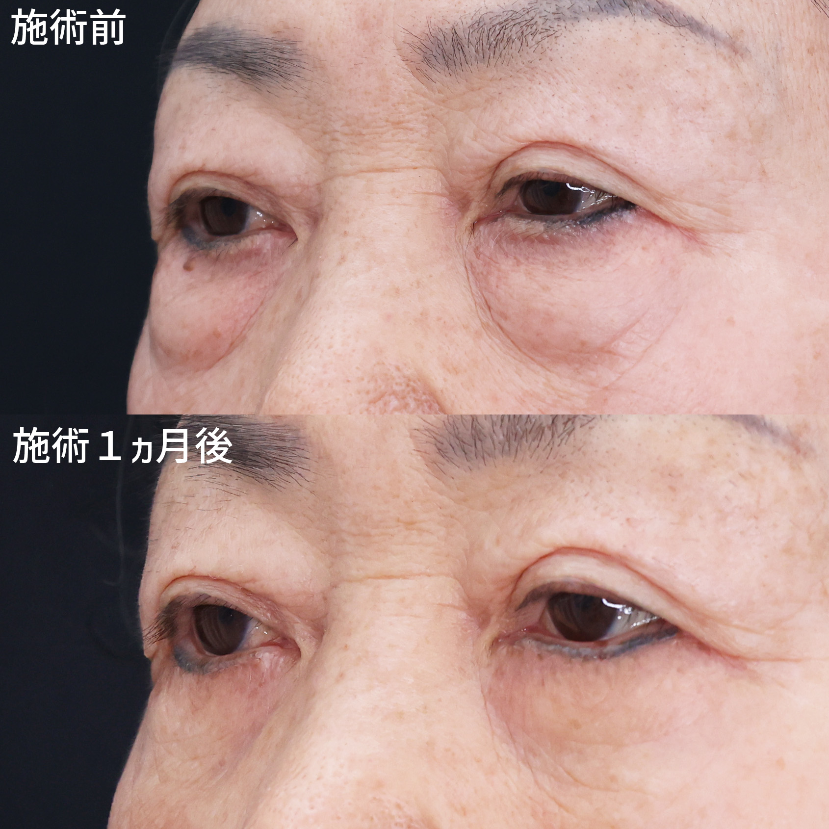 下眼瞼切開術（クマ・たるみとり）/下眼瞼脱脂術（目の下のたるみ取り・目の下の脂肪ふくらみ取り）の症例写真 施術前後 