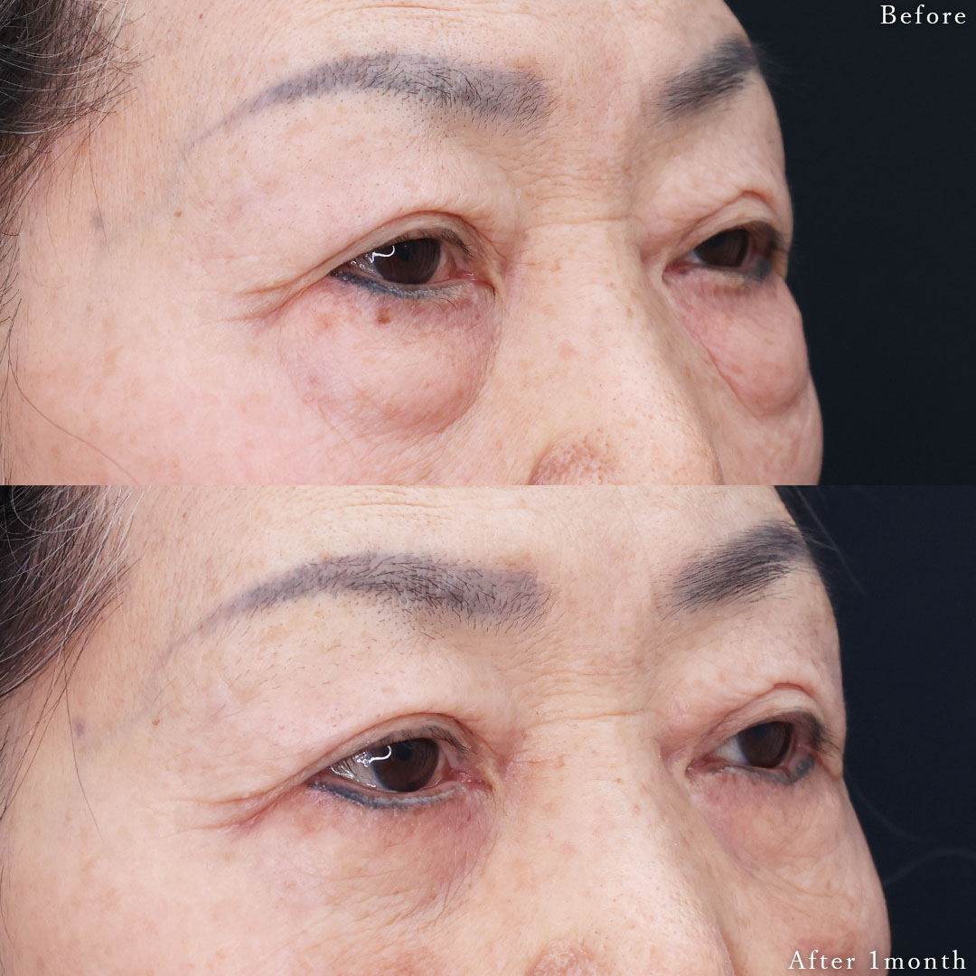 下眼瞼切開術（クマ・たるみとり）/下眼瞼脱脂術（目の下のたるみ取り・目の下の脂肪ふくらみ取り）の症例写真 施術前後 