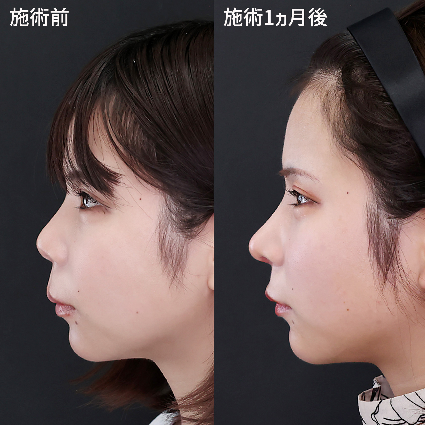 鼻整形　１ヵ月後　横顔の比較