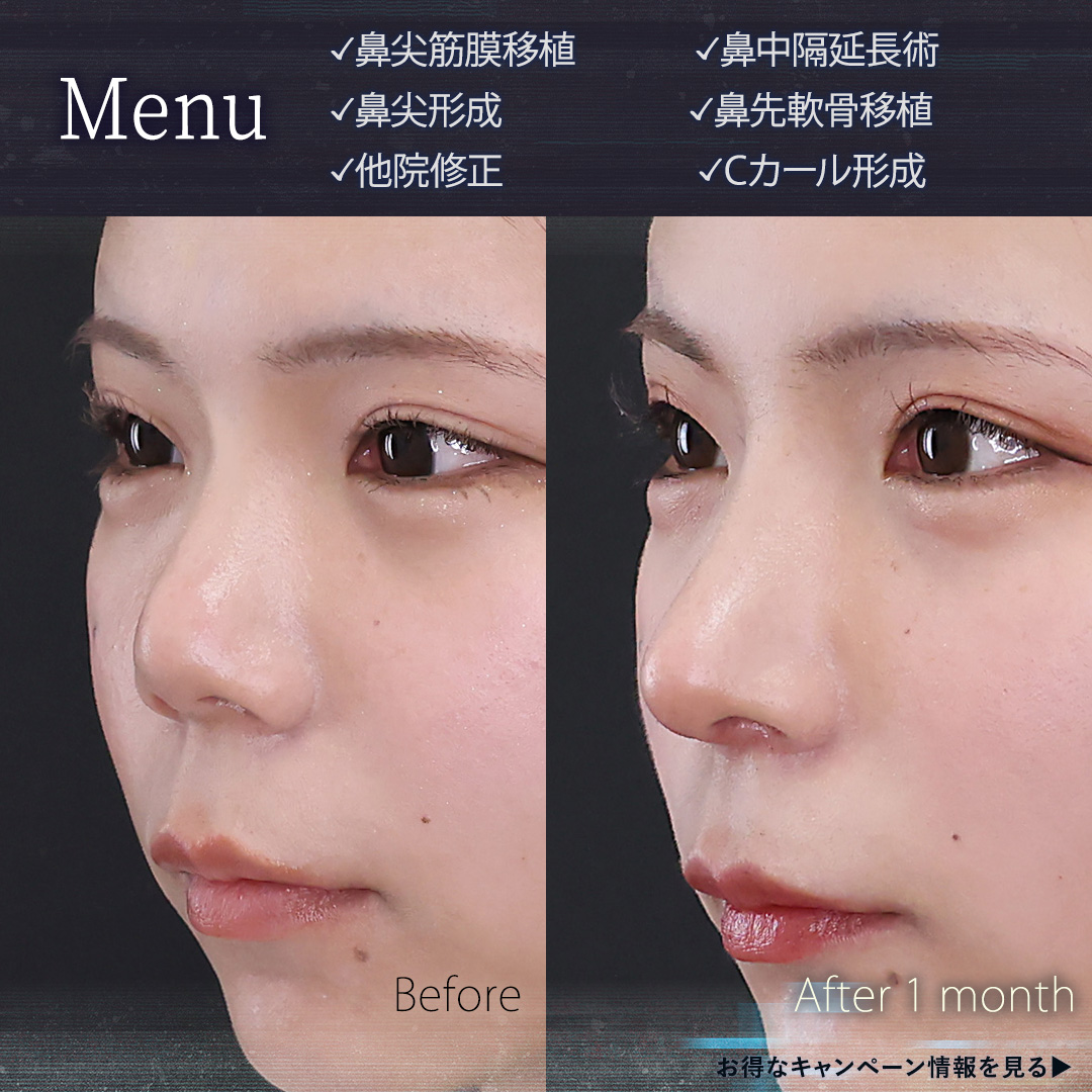 鼻尖形成・鼻尖縮小/鼻先軟骨移植/鼻中隔延長術の症例写真 施術前後 