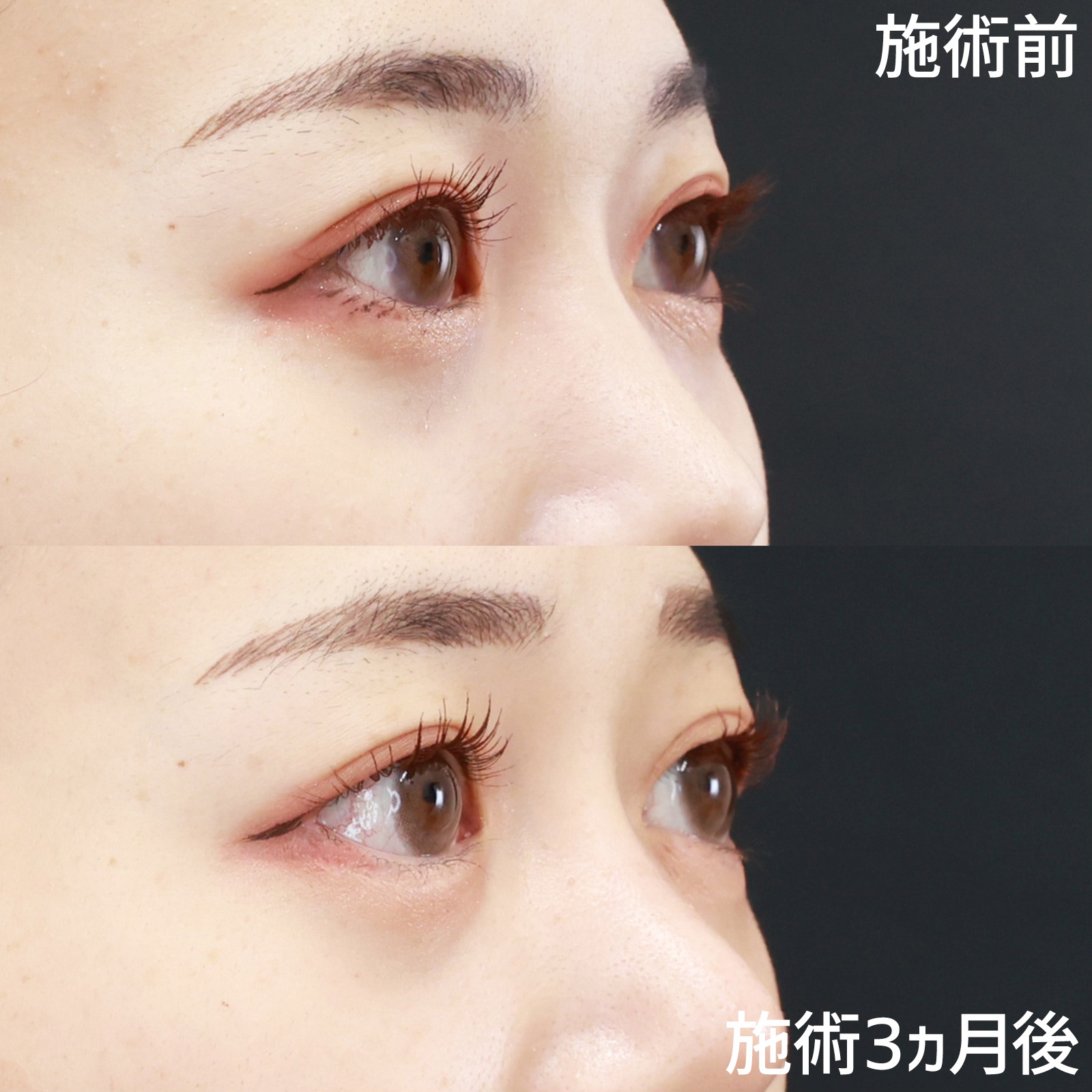 目尻靭帯移動術/目尻切開術/グラマラスライン（タレ目形成）の症例写真 施術前後 