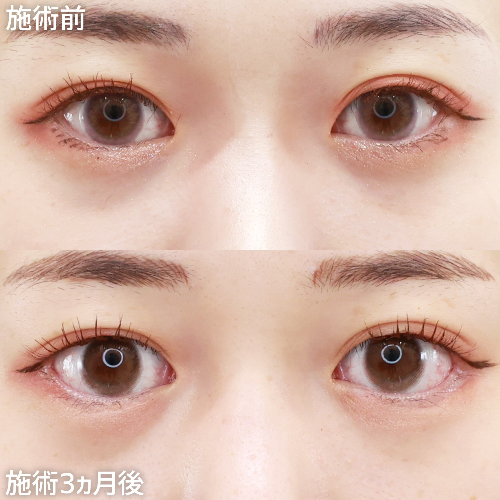 【たれ目フルセット】目元を縦と横に大きく!理想的なデカ目に変身!