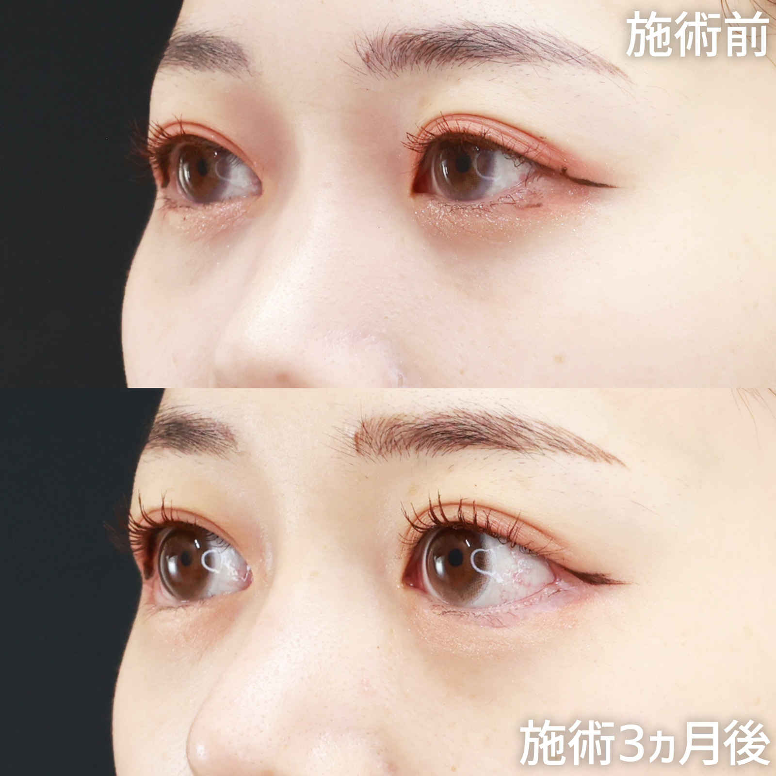 目尻靭帯移動術/目尻切開術/グラマラスライン（タレ目形成）の症例写真 施術前後 