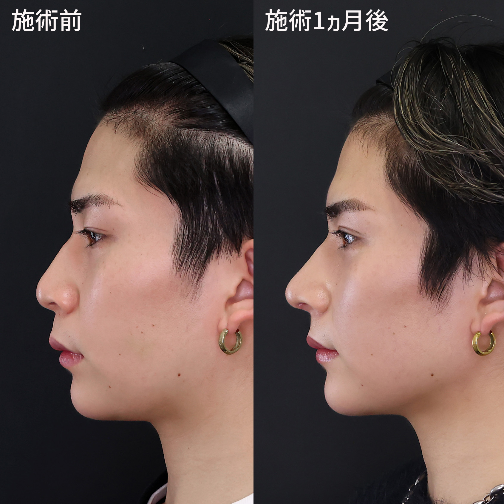 鼻先 軟骨移植 痛み 仙台の症例写真・画像・ビフォーアフター