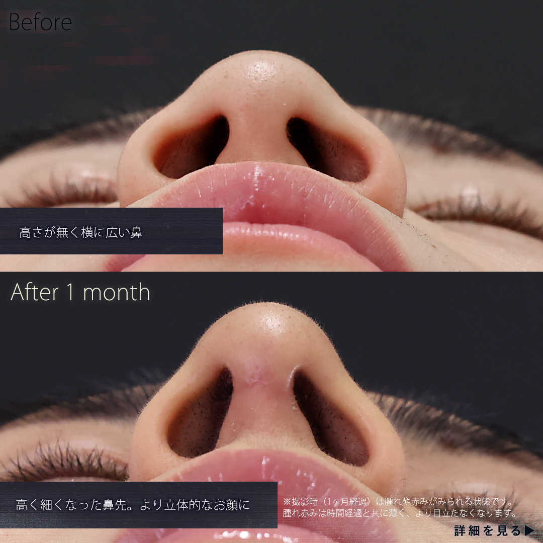 鼻中隔延長術/鼻先軟骨移植/鼻尖形成・鼻尖縮小の症例写真 施術前後 