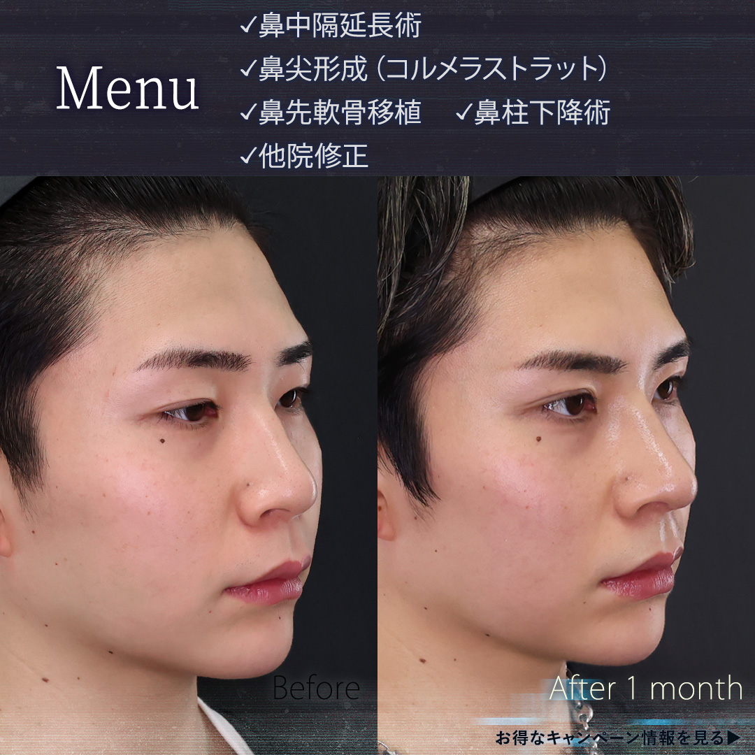 鼻中隔延長術/鼻先軟骨移植/鼻尖形成・鼻尖縮小の症例写真 施術前後 