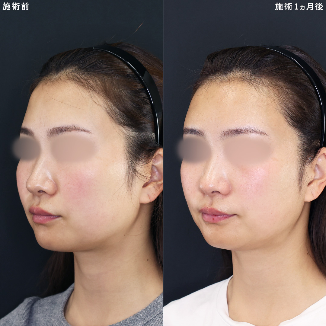 顔の脂肪注入(コンデンスリッチフェイス)の症例写真 施術前後 