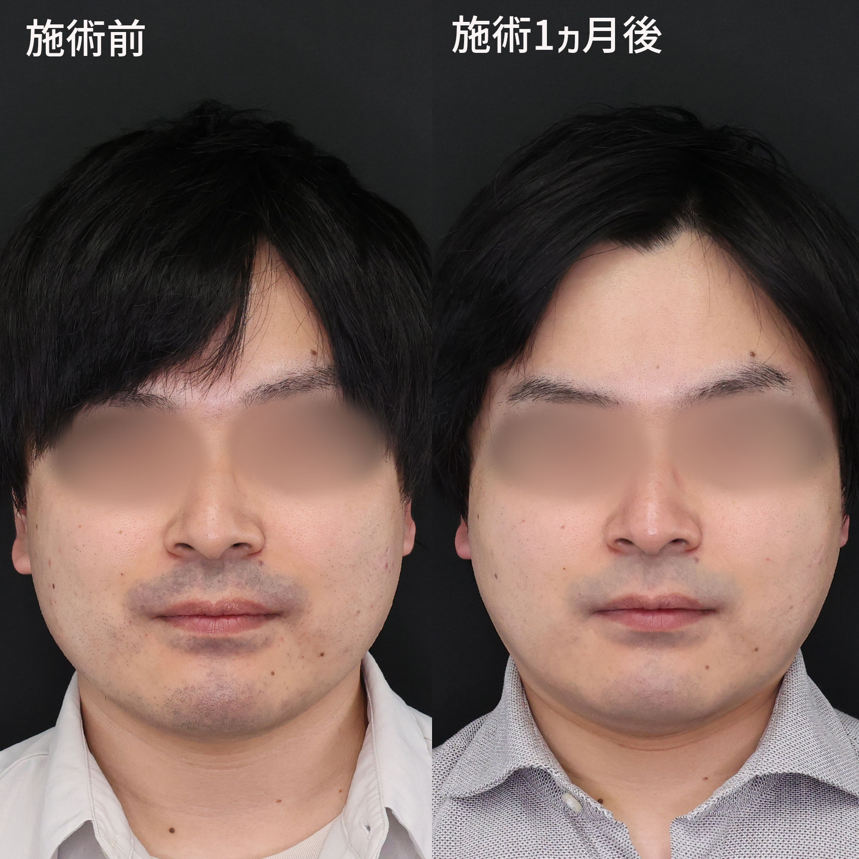 本来の輪郭を引き出す！メンズ小顔整形