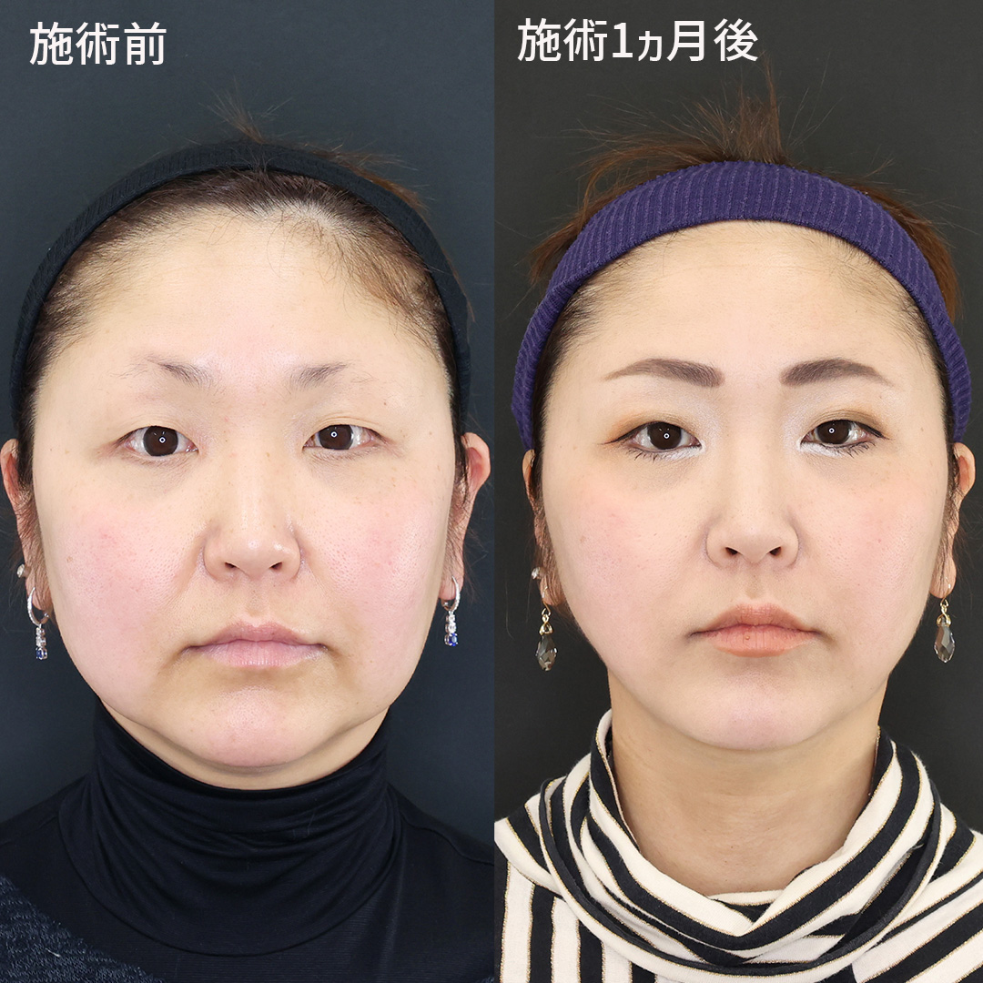 糸リフト×脂肪除去｜最速で顔痩せ