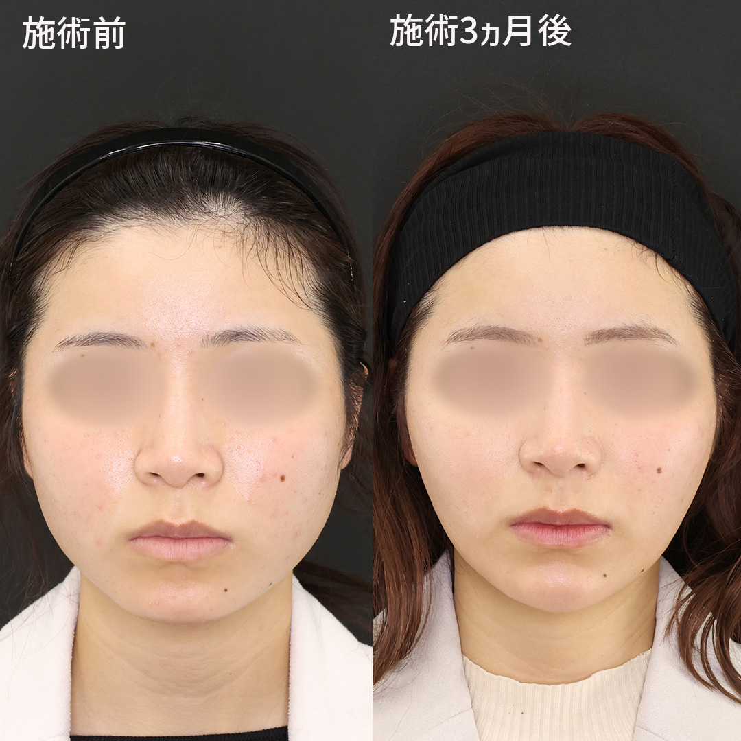 【確実な変化をもたらす】最速小顔整形