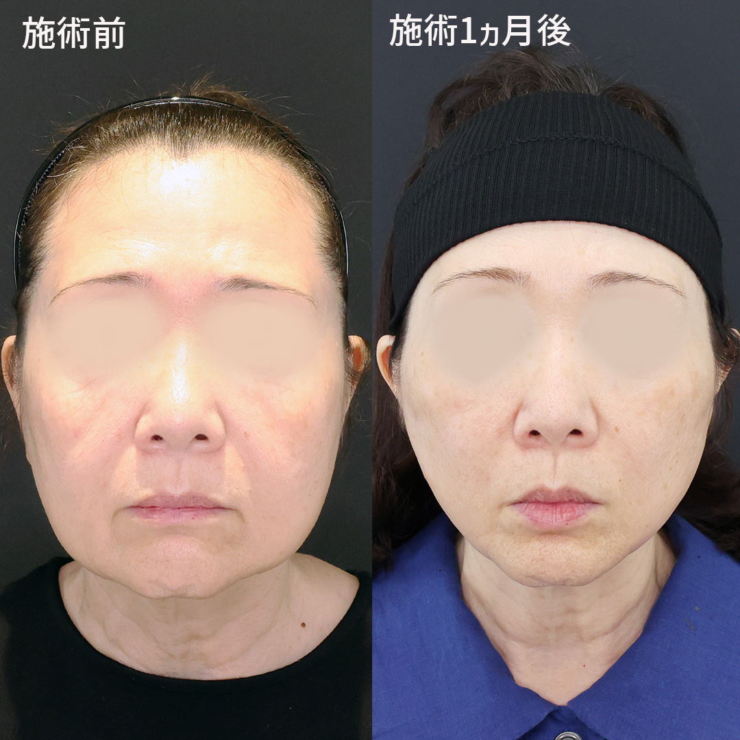 【弛みでもう悩まない】別人級小顔術