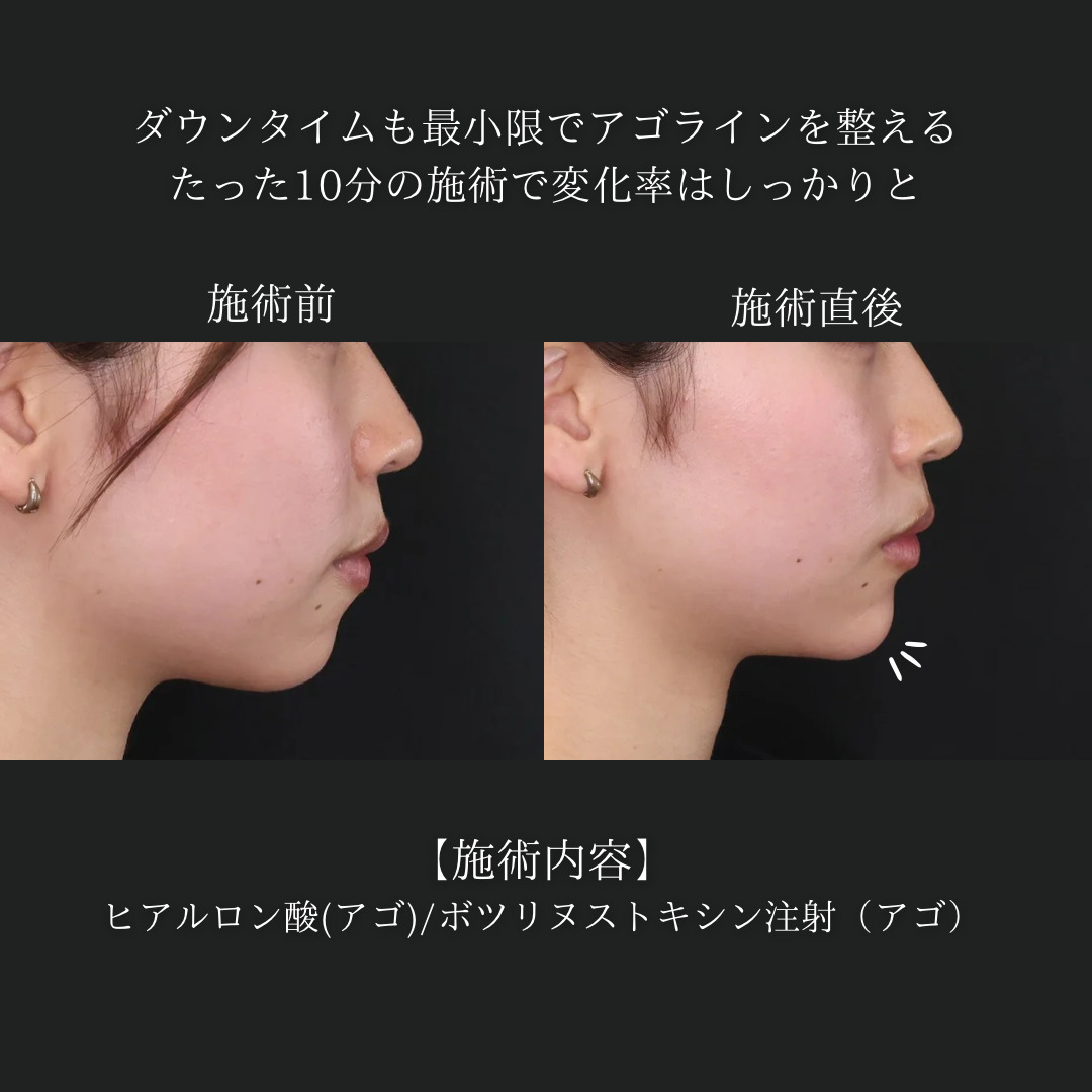 顎のヒアルロン酸注射/エラボトックス注射の症例写真 施術前後