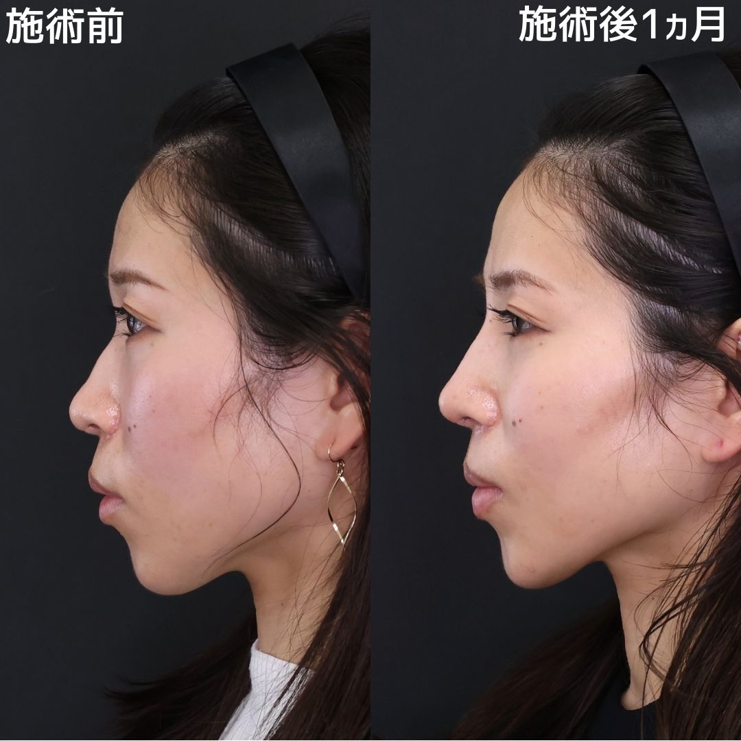 【鼻整形】ナチュラルに変化！すっきりと高さのあるお鼻に