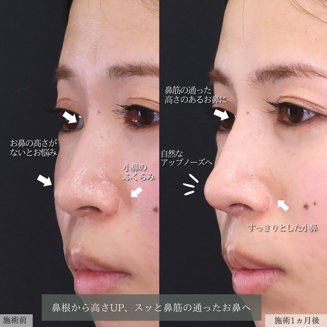 隆鼻術（プロテーゼ・自家組織）/鼻尖形成・鼻尖縮小/鼻先軟骨移植の症例写真 施術前後 