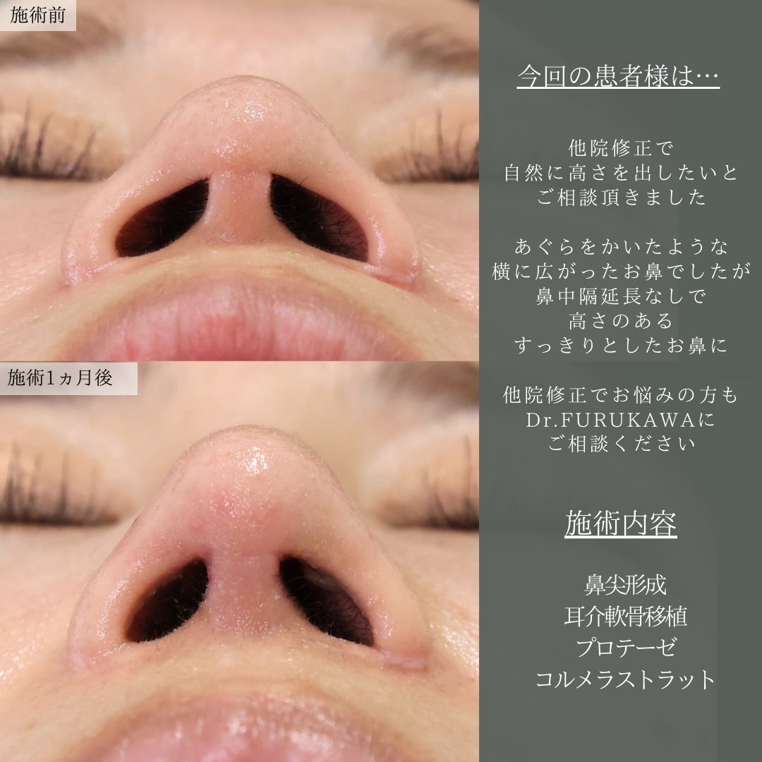 隆鼻術（プロテーゼ・自家組織）/鼻尖形成・鼻尖縮小/鼻先軟骨移植の症例写真 施術前後 