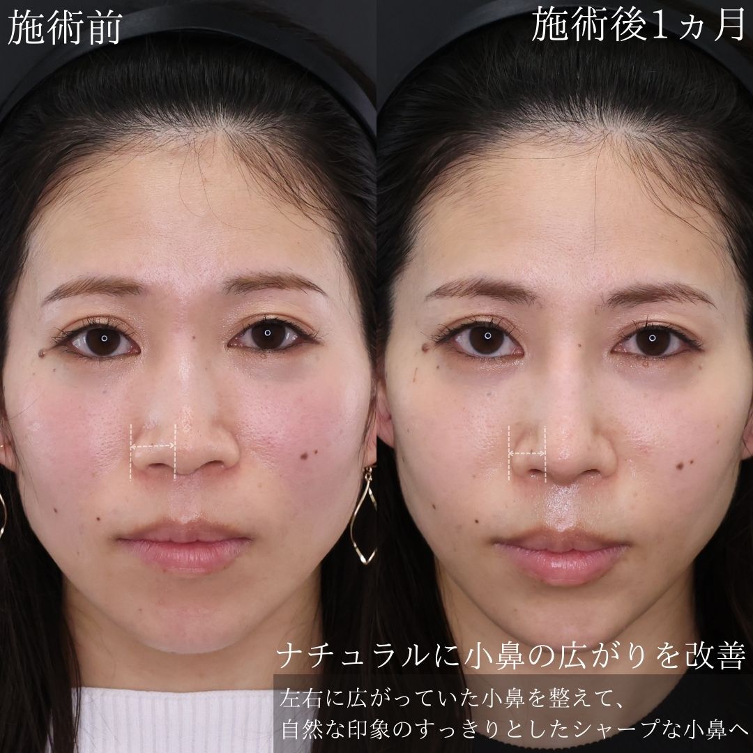 隆鼻術（プロテーゼ・自家組織）/鼻尖形成・鼻尖縮小/鼻先軟骨移植の症例写真 施術前後 