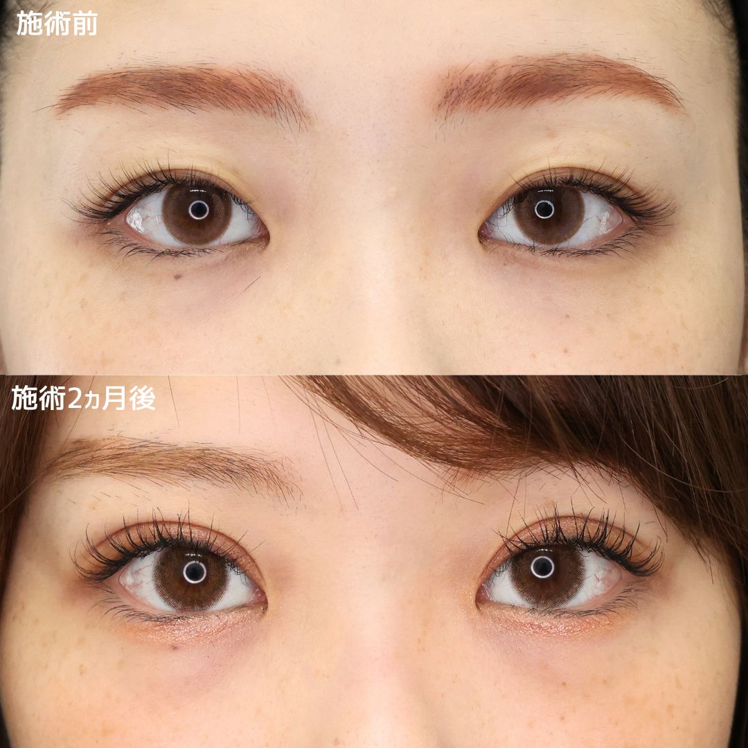 《二重埋没法》1ミリ単位でこだわる目元術