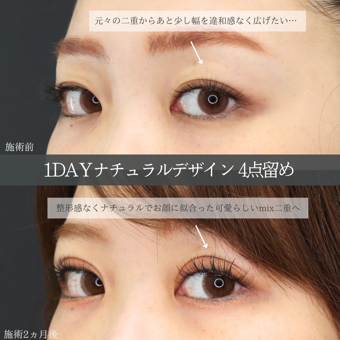 二重埋没法の症例写真 施術前後 