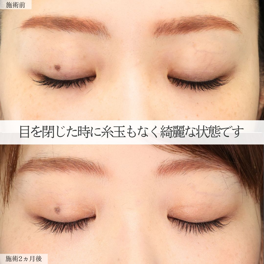 二重埋没法の症例写真 施術前後 