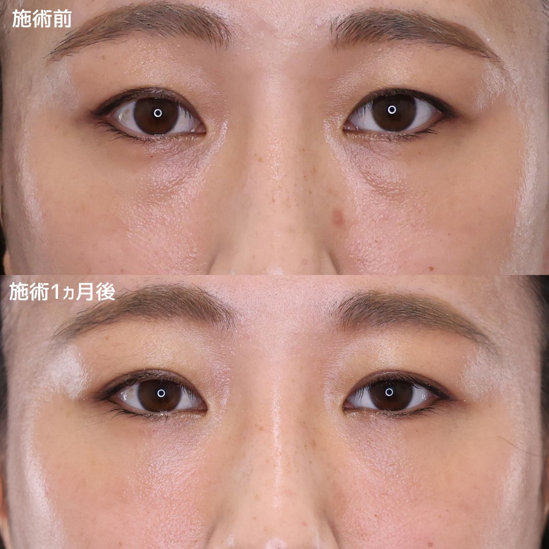 《クマ取り》メイクなしでも自信が持てる