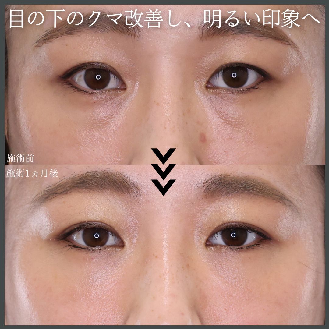 下眼瞼脱脂術（目の下のたるみ取り・目の下の脂肪ふくらみ取り）/顔の脂肪注入(コンデンスリッチフェイス)の症例写真 施術前後 