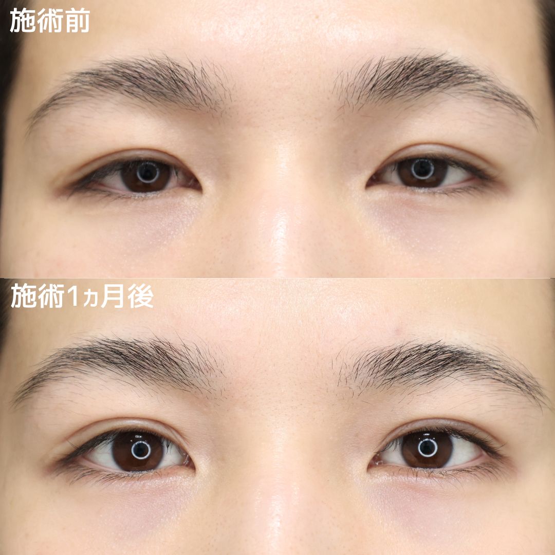 《二重埋没法》元眼科医が作る別人級二重術