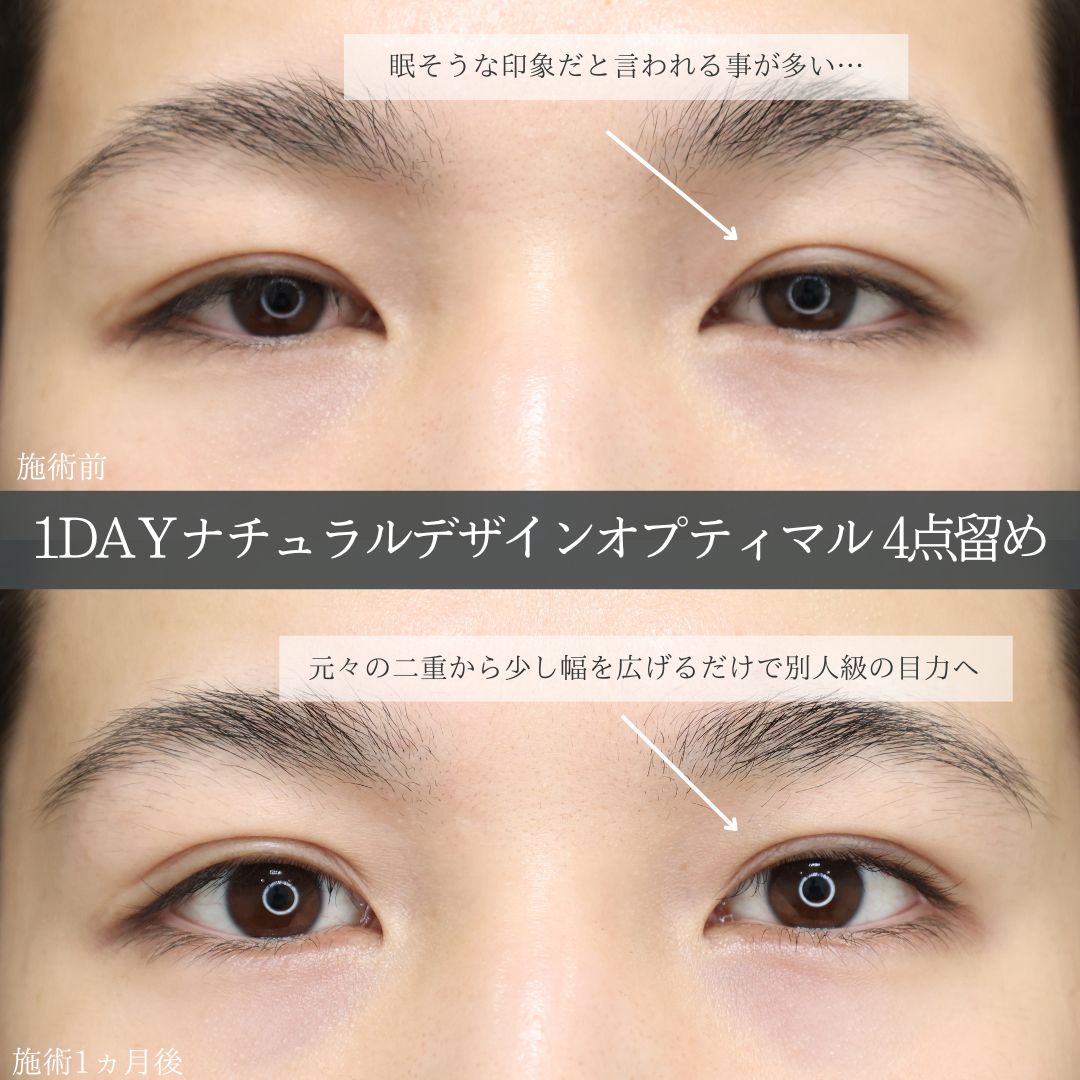 二重埋没法/涙袋形成(ヒアルロン酸注射)の症例写真 施術前後