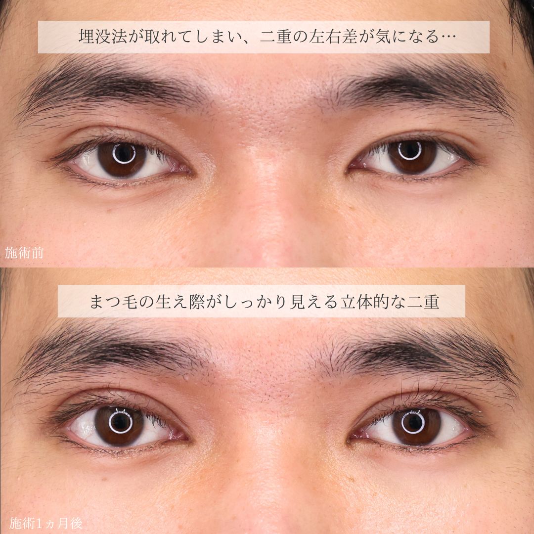 上眼瞼切開術の症例写真 施術前後 