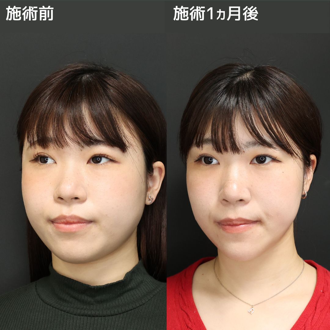 《小顔整形》Instagram症例を見て決断しました
