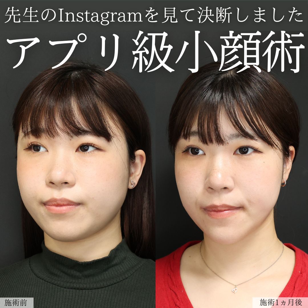 TAC式 ツヤ肌コラーゲンリフト®/ジョールファット除去/Lラインファット除去（エラ下脂肪除去）の症例写真 施術前後 