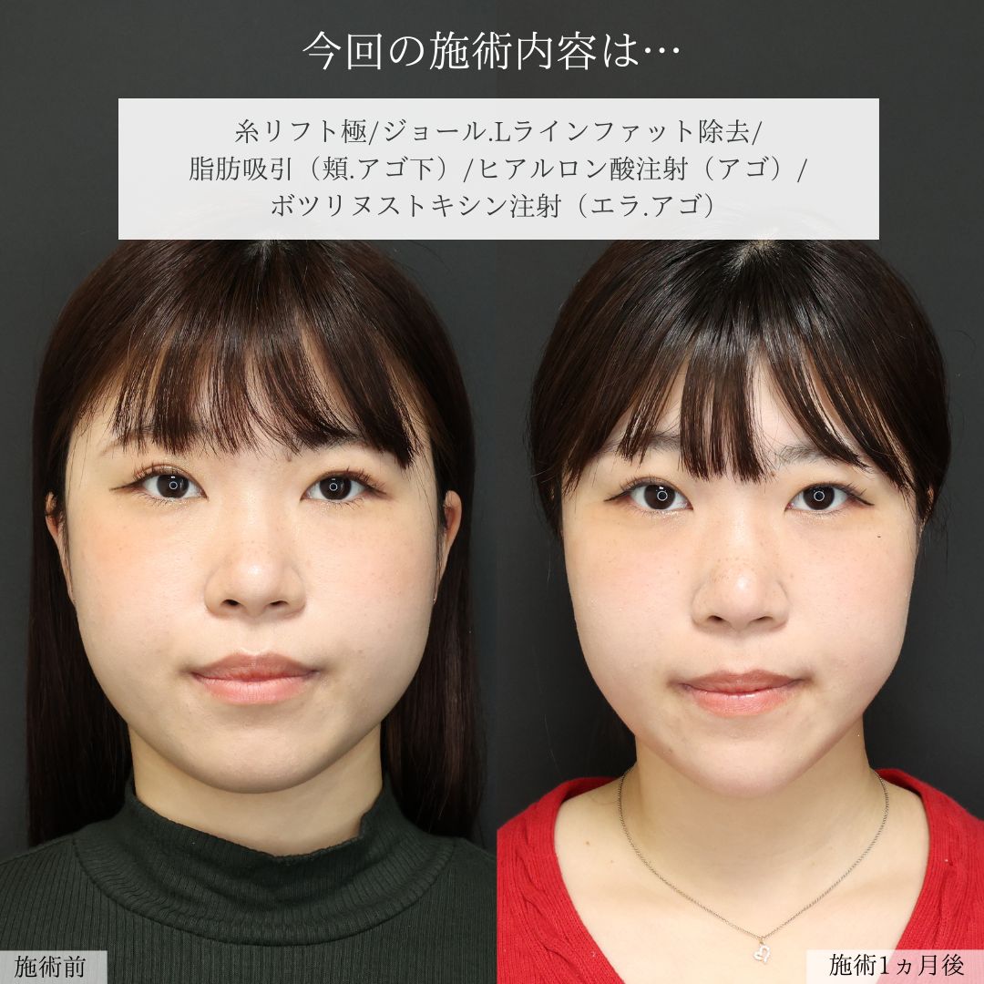 TAC式 ツヤ肌コラーゲンリフト®/ジョールファット除去/Lラインファット除去（エラ下脂肪除去）の症例写真 施術前後 