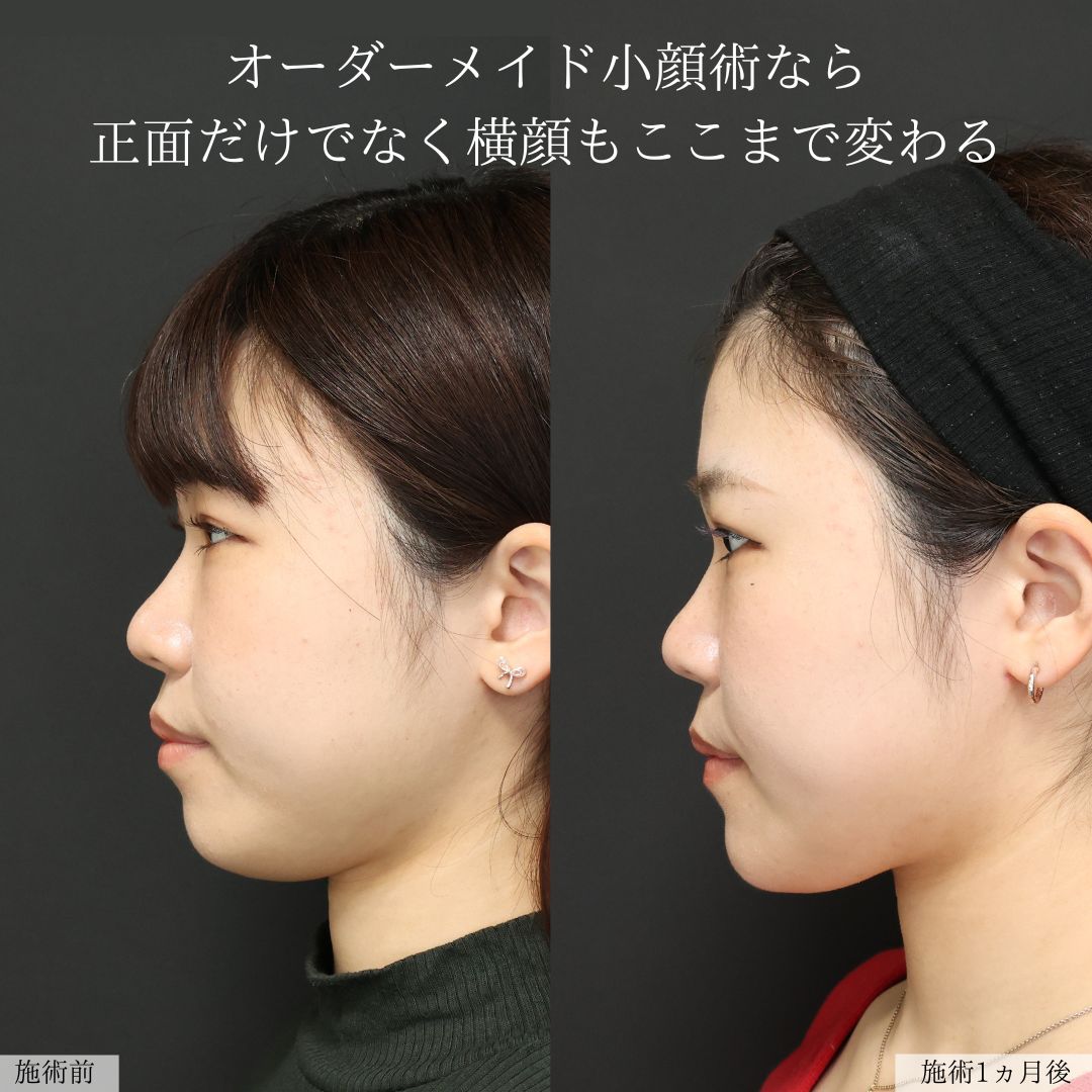 TAC式 ツヤ肌コラーゲンリフト®/ジョールファット除去/Lラインファット除去（エラ下脂肪除去）の症例写真 施術前後 