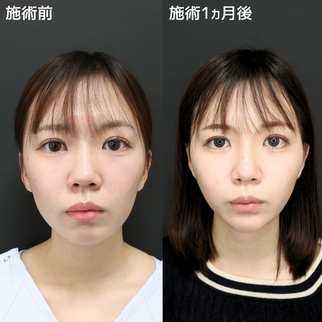 《オーダーメイド小顔》でシャープな理想の輪郭へ