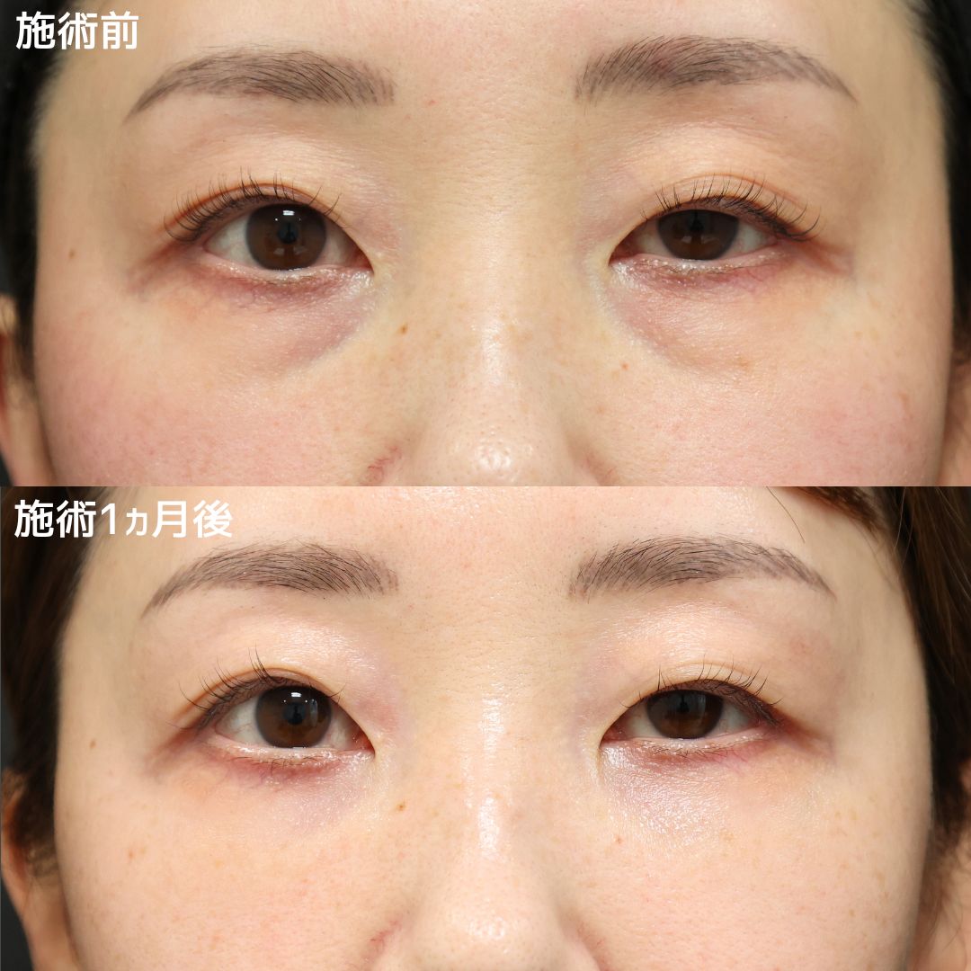 《クマ取り》のみでここまでお顔は変わります