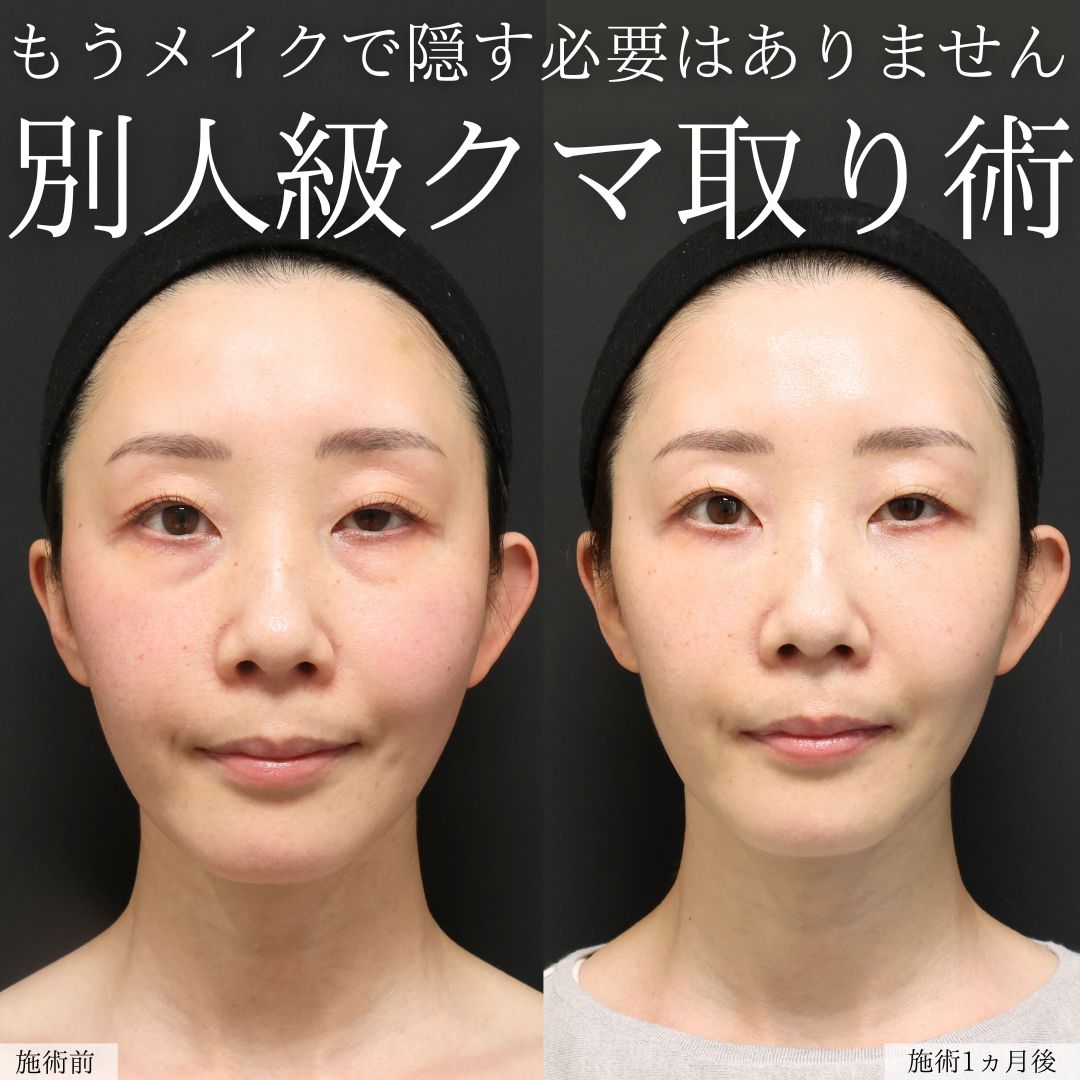 下眼瞼脱脂術（目の下のたるみ取り・目の下の脂肪ふくらみ取り）の症例写真 施術前後 