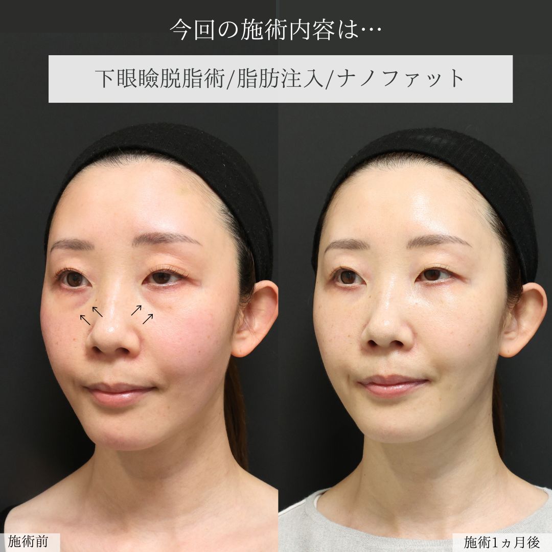 下眼瞼脱脂術（目の下のたるみ取り・目の下の脂肪ふくらみ取り）の症例写真 施術前後 