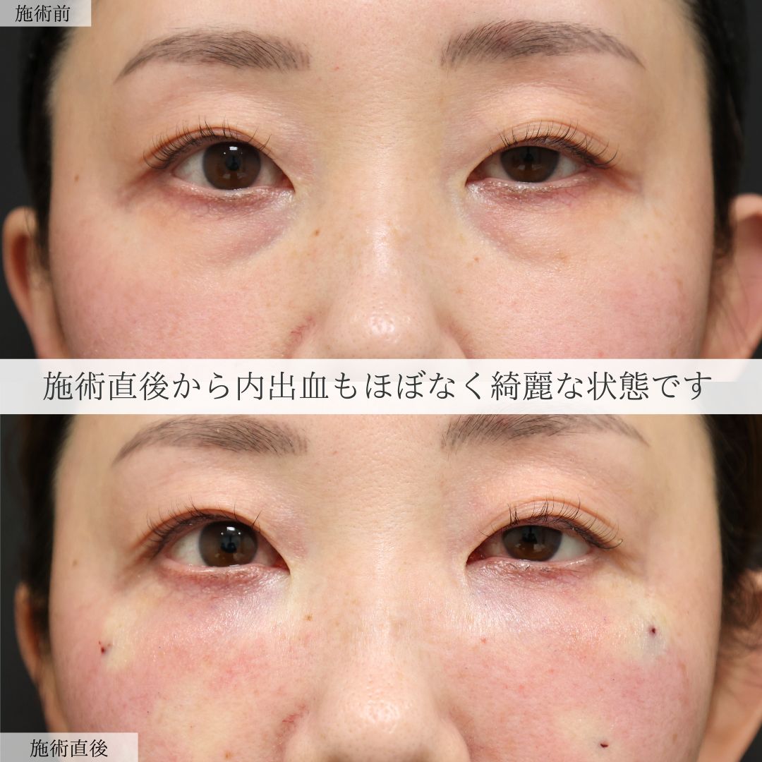 下眼瞼脱脂術（目の下のたるみ取り・目の下の脂肪ふくらみ取り）の症例写真 施術前後 