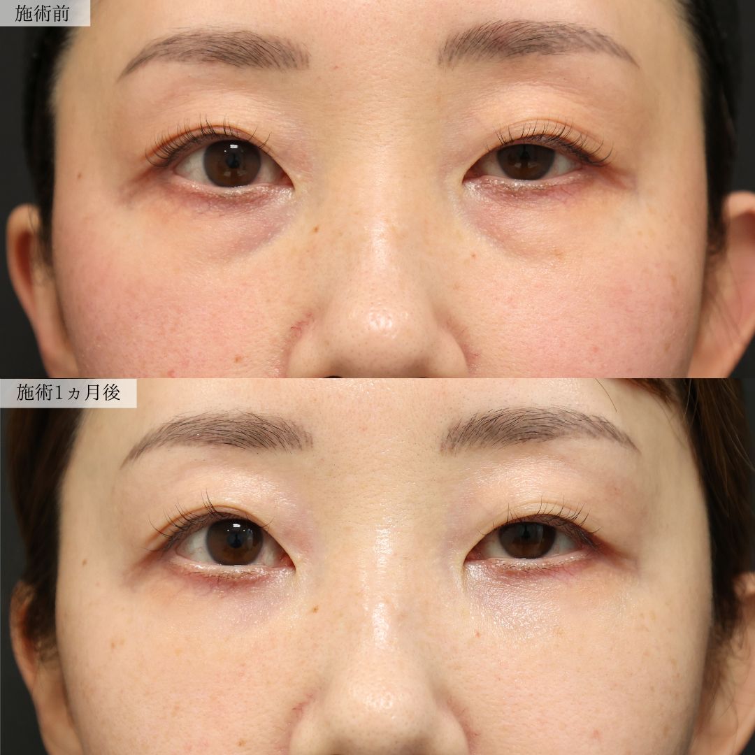 下眼瞼脱脂術（目の下のたるみ取り・目の下の脂肪ふくらみ取り）の症例写真 施術前後 