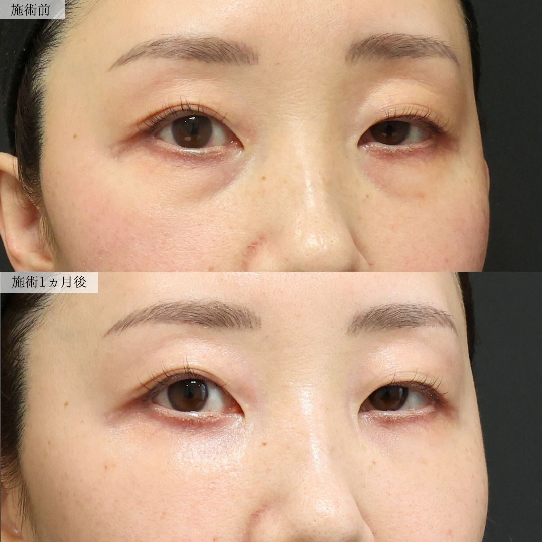 下眼瞼脱脂術（目の下のたるみ取り・目の下の脂肪ふくらみ取り）の症例写真 施術前後 