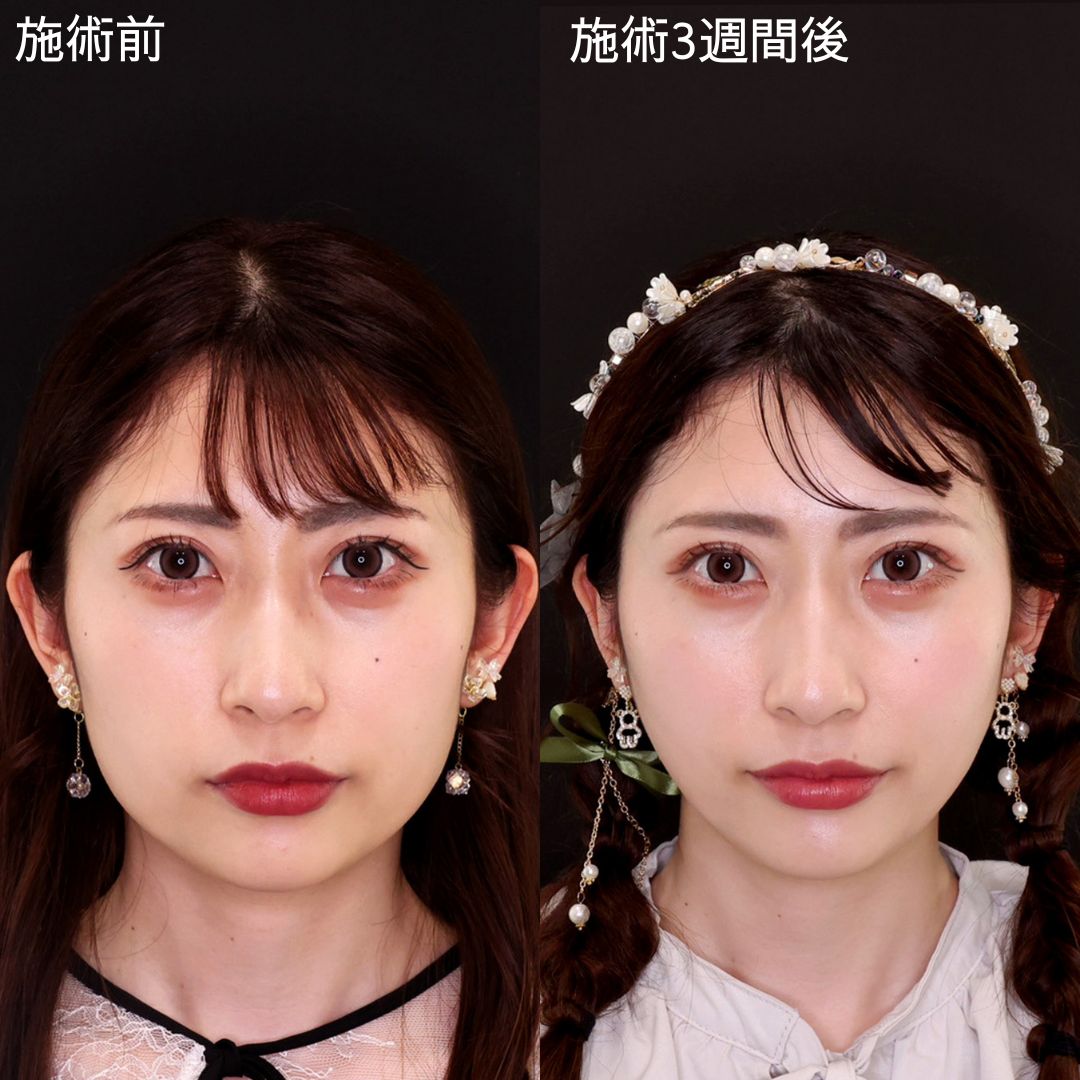 糸リフトのみで韓ドル級の小顔に導く【糸リフト】