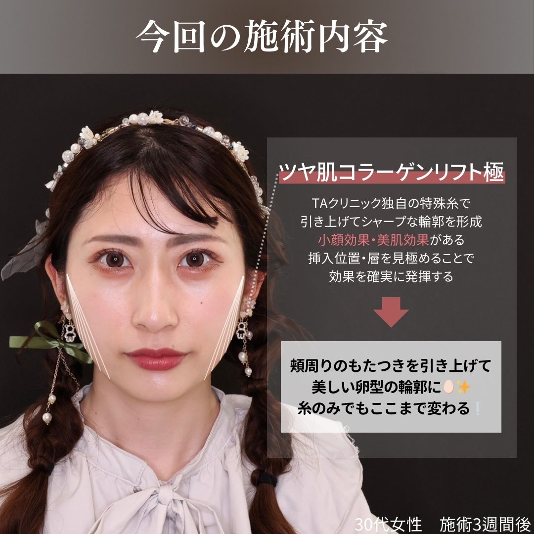 TAC式 ツヤ肌コラーゲンリフト®の症例写真 施術前後