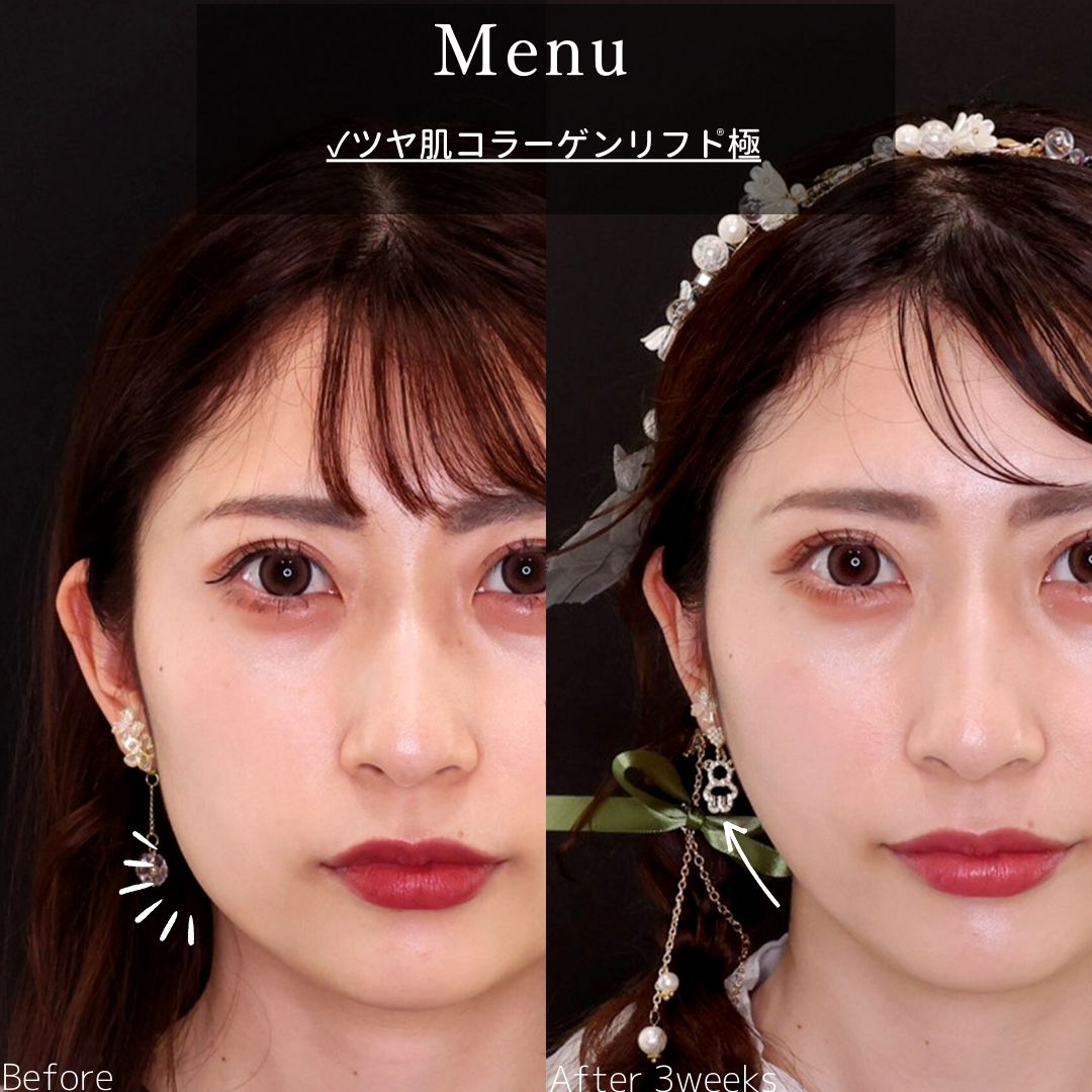 TAC式 ツヤ肌コラーゲンリフト®の症例写真 施術前後