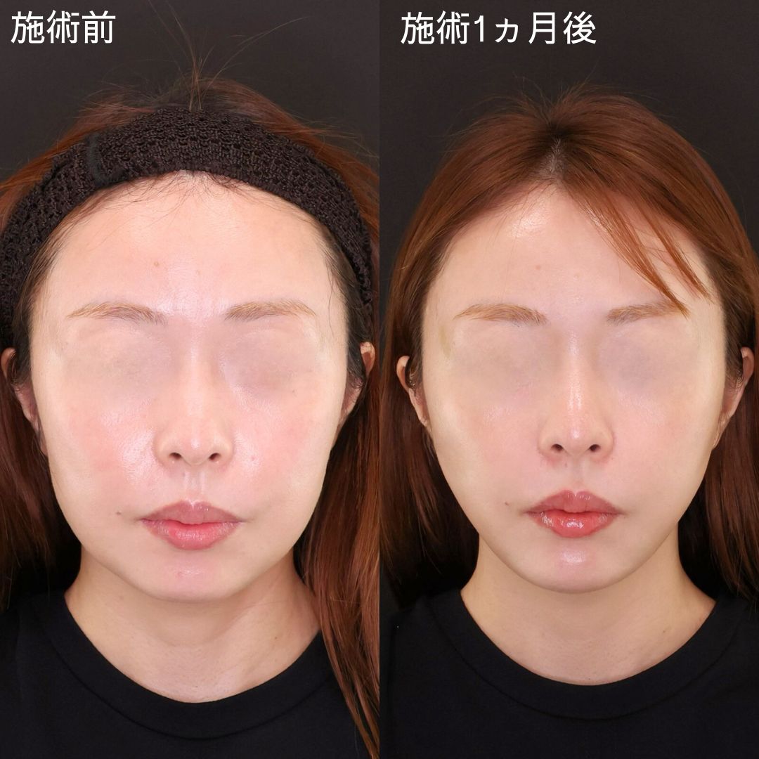 弛みを改善し口元スッキリ！Dr.石橋の小顔術【糸リフト×アゴヒアルロン酸注射】